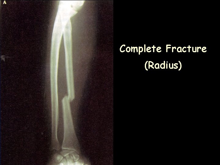 Complete Fracture (Radius)  Complete Fracture (Radius)