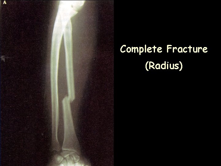 Complete Fracture (Radius) 