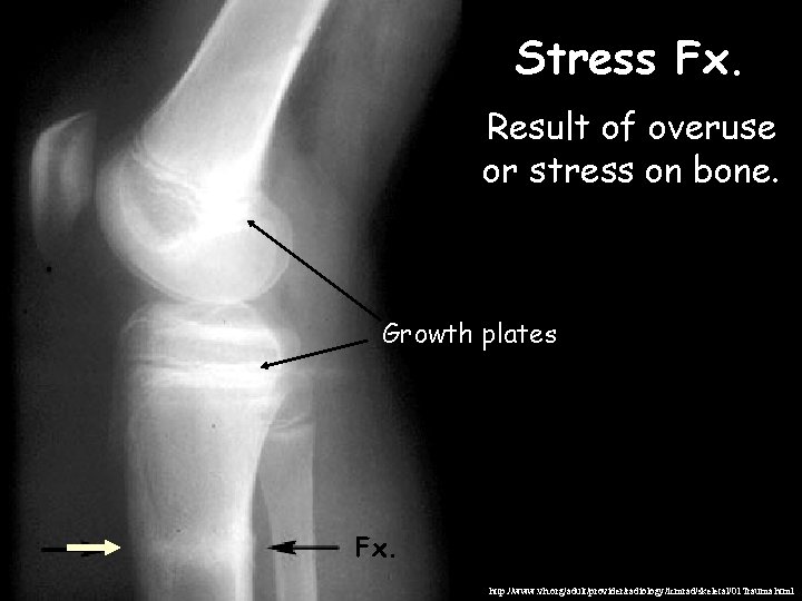 Stress Fx. Result of overuse or stress on bone. Growth plates Fx. http: //www.