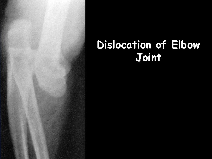 Dislocation of Elbow Joint 