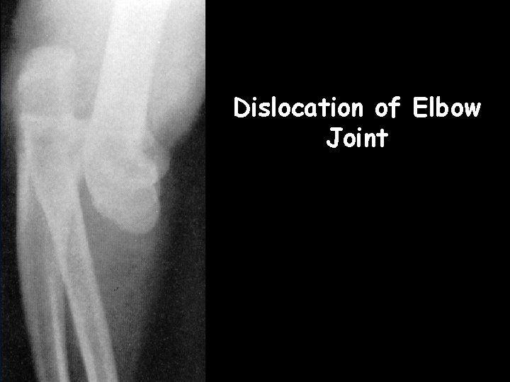 Dislocation of Elbow Joint  Dislocation of Elbow Joint