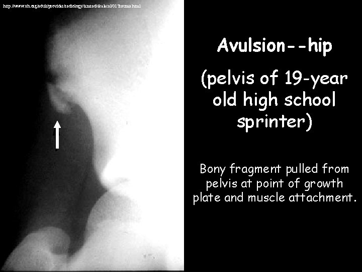 http: //www. vh. org/adult/provider/radiology/icmrad/skeletal/01 Trauma. html Avulsion--hip (pelvis of 19 -year old high school