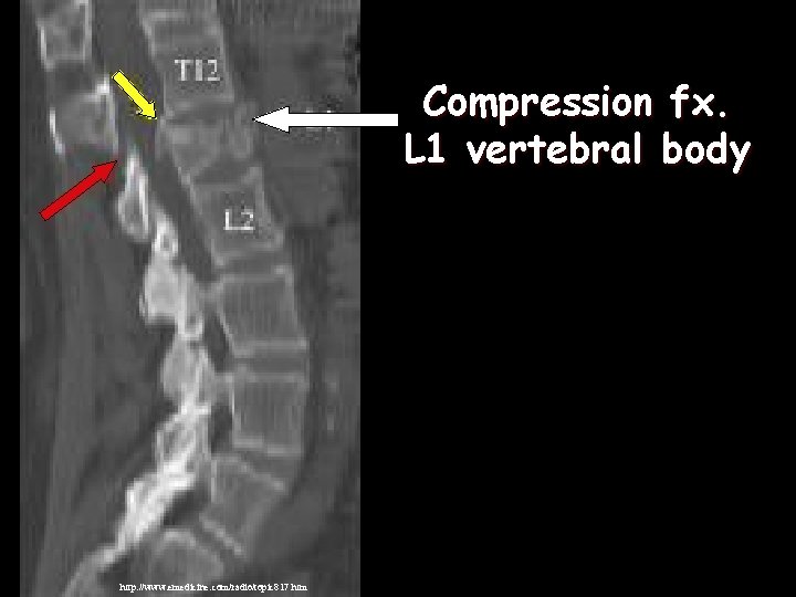 Compression fx. L 1 vertebral body http: //www. emedicine. com/radio/topic 817. htm  Compression fx. L 1 vertebral body http: //www. emedicine. com/radio/topic 817. htm