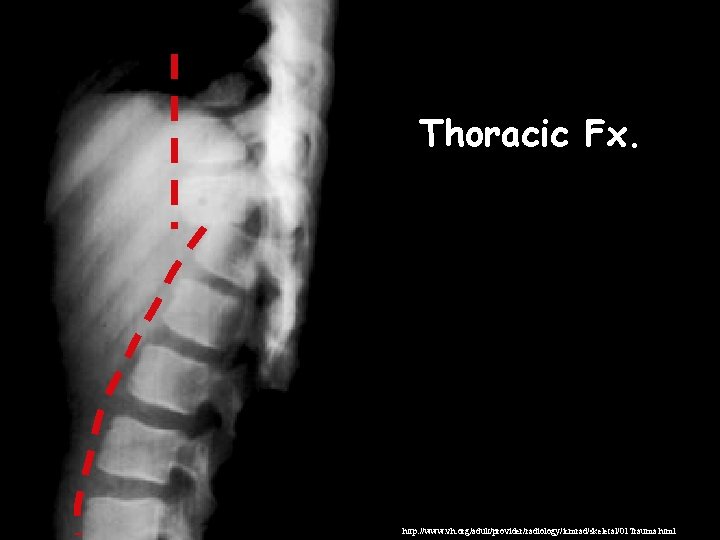 Thoracic Fx. http: //www. vh. org/adult/provider/radiology/icmrad/skeletal/01 Trauma. html 