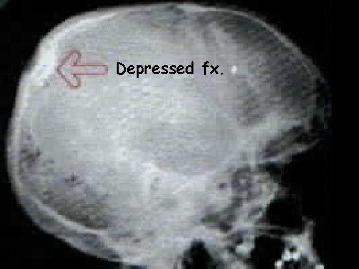 Depressed fx.  Depressed fx.