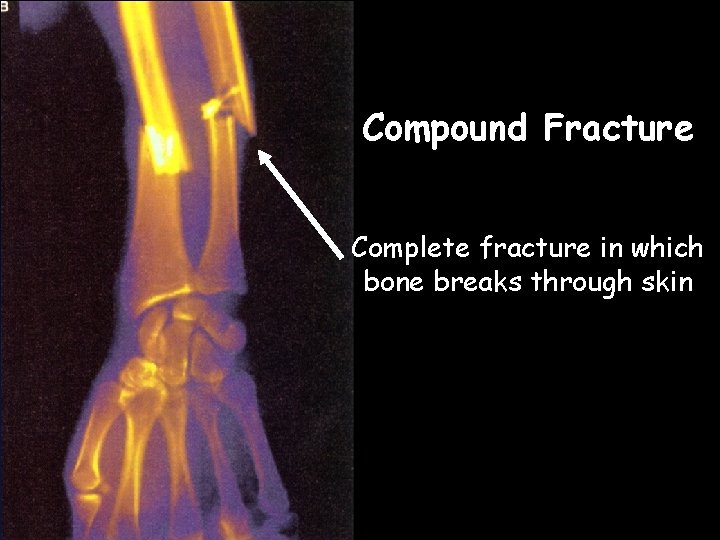 Compound Fracture Complete fracture in which bone breaks through skin  Compound Fracture Complete fracture in which bone breaks through skin