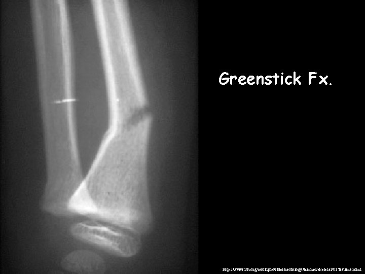 Greenstick Fx. http: //www. vh. org/adult/provider/radiology/icmrad/skeletal/01 Trauma. html 