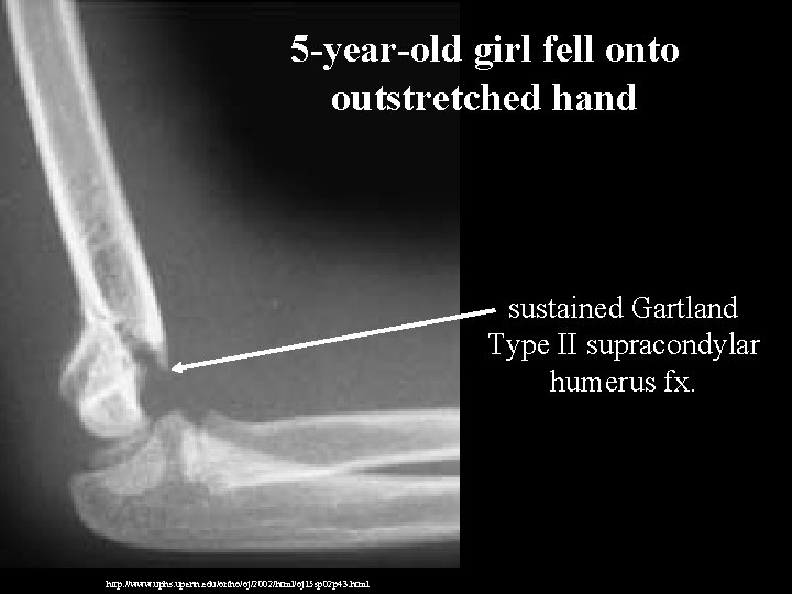 5 -year-old girl fell onto outstretched hand sustained Gartland Type II supracondylar humerus fx. 5 -year-old girl fell onto outstretched hand sustained Gartland Type II supracondylar humerus fx.