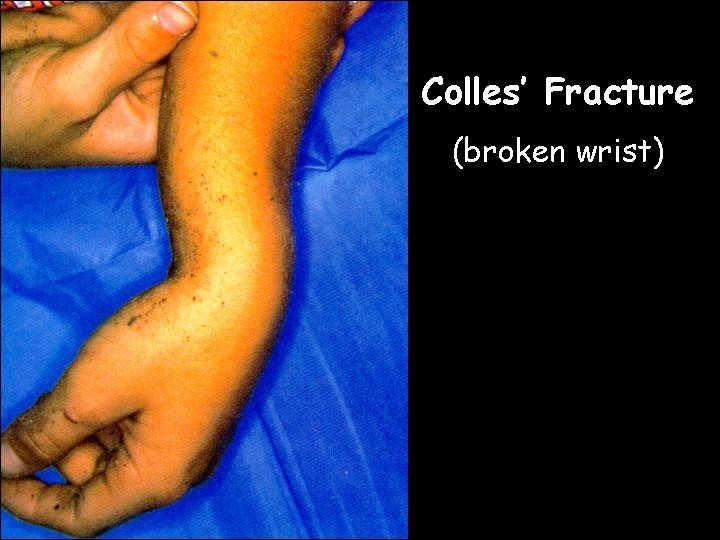 Colles’ Fracture (broken wrist)  Colles’ Fracture (broken wrist)