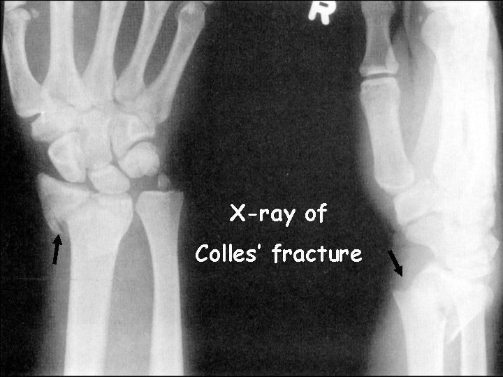 X-ray of Colles’ fracture  X-ray of Colles’ fracture