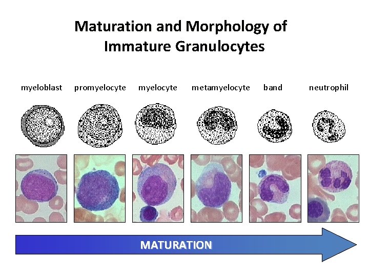 Maturation and Morphology of Immature Granulocytes myeloblast promyelocyte metamyelocyte MATURATION band neutrophil 