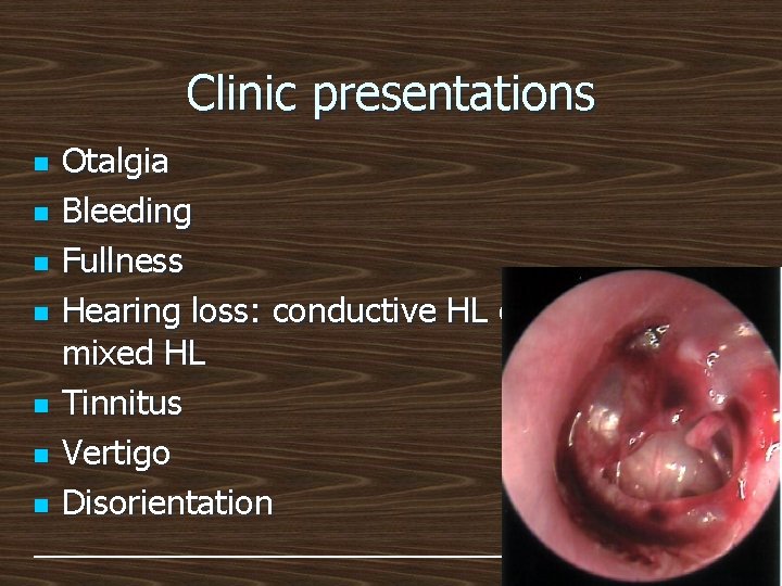 Clinic presentations n n n n Otalgia Bleeding Fullness Hearing loss: conductive HL or