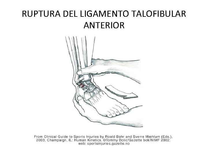 RUPTURA DEL LIGAMENTO TALOFIBULAR ANTERIOR 