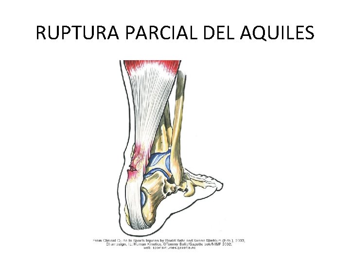 RUPTURA PARCIAL DEL AQUILES 