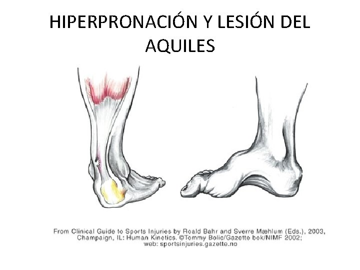 HIPERPRONACIÓN Y LESIÓN DEL AQUILES 