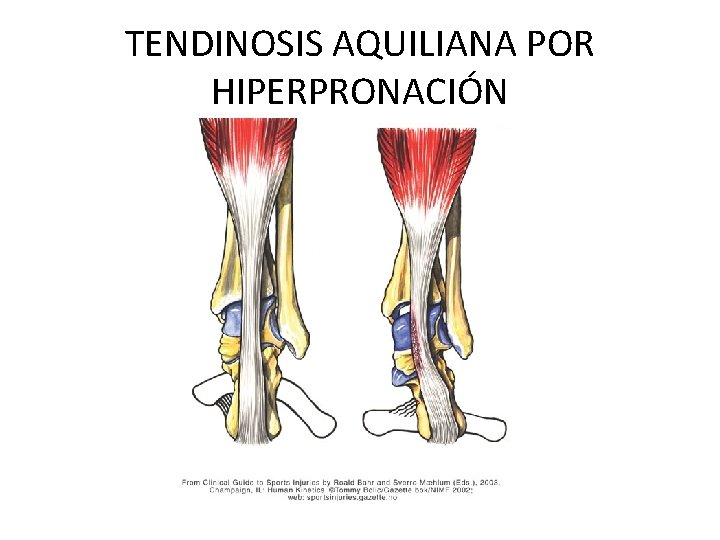 TENDINOSIS AQUILIANA POR HIPERPRONACIÓN 