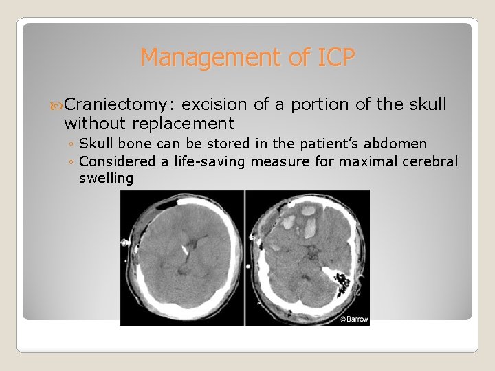 Management of ICP Craniectomy: excision of a portion of the skull without replacement ◦