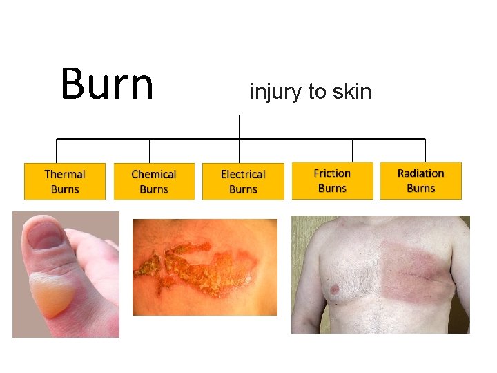 Burn injury to skin 