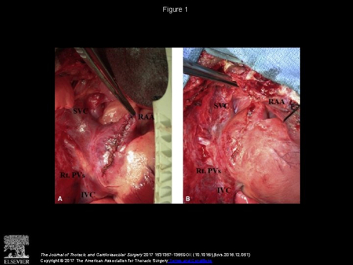 Figure 1 The Journal of Thoracic and Cardiovascular Surgery 2017 1531357 -1365 DOI: (10.