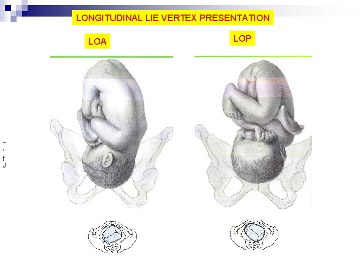 LONGITUDINAL LIE VERTEX PRESENTATION LOA ~ ' t J LOP 