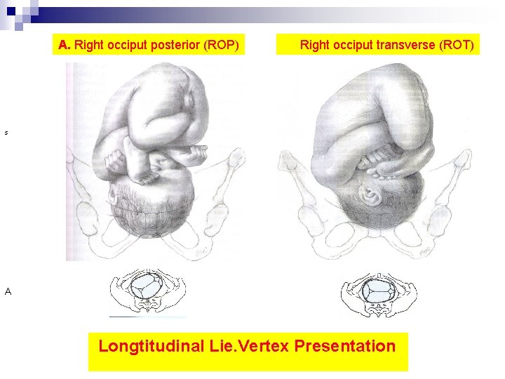 A. Right occiput posterior (ROP) Right occiput transverse (ROT) s A Longtitudinal Lie. Vertex