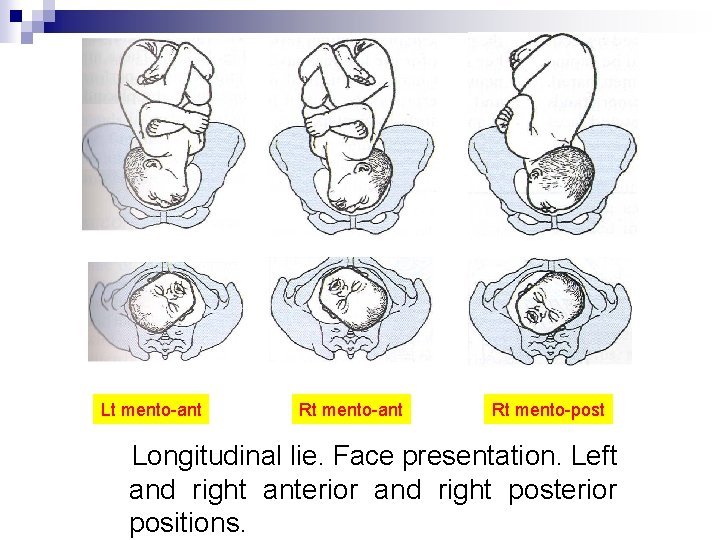 Lt mento ant Rt mento post Longitudinal lie. Face presentation. Left and right anterior