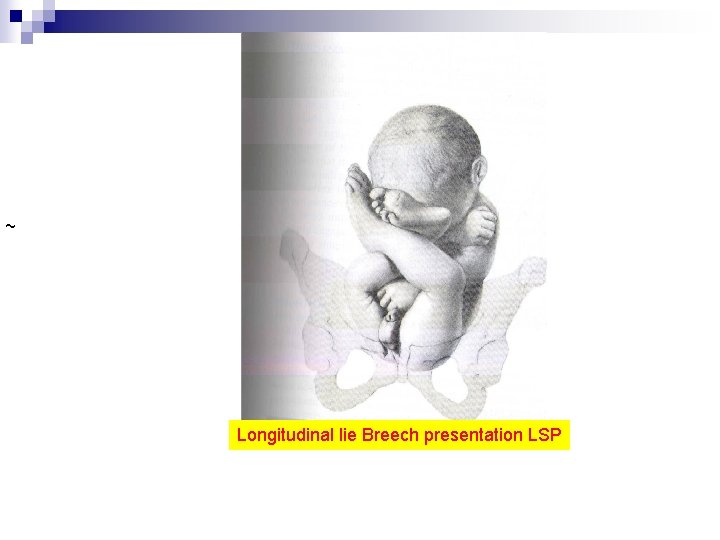 ~ Longitudinal lie Breech presentation LSP 