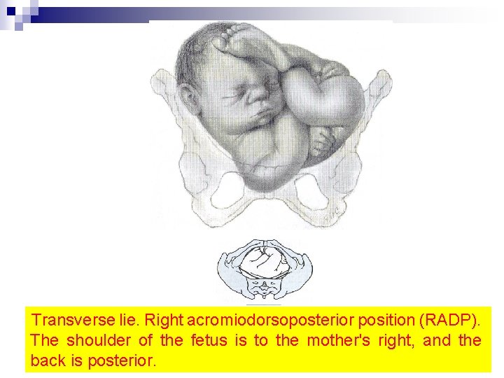 Transverse lie. Right acromiodorsoposterior position (RADP). The shoulder of the fetus is to the