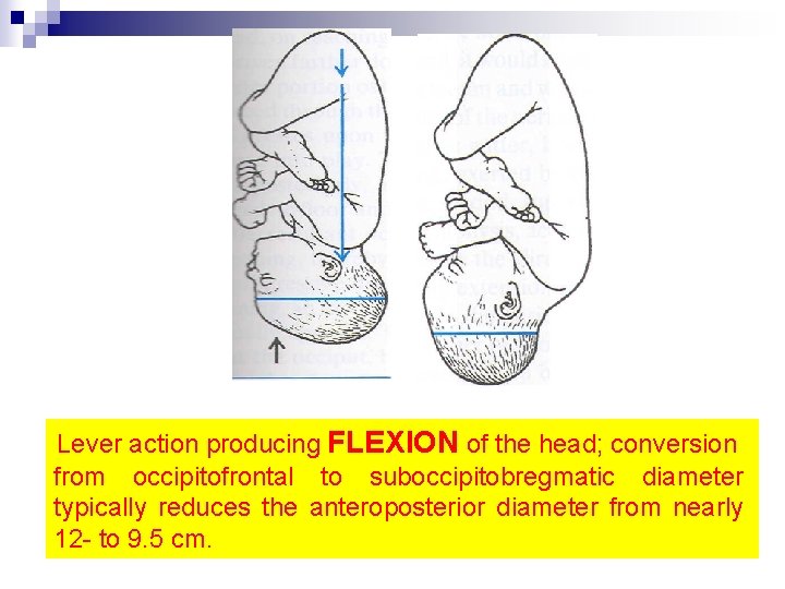 Lever action producing FLEXION of the head; conversion from occipitofrontal to suboccipitobregmatic diameter typically