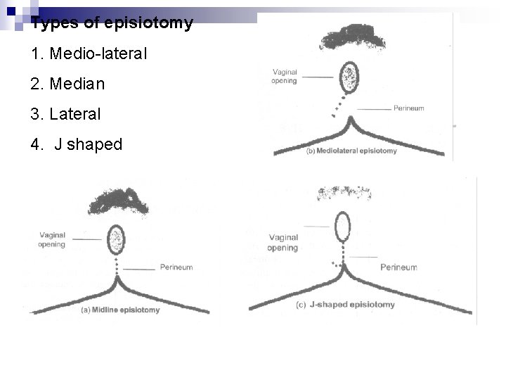 Types of episiotomy 1. Medio lateral 2. Median 3. Lateral 4. J shaped 