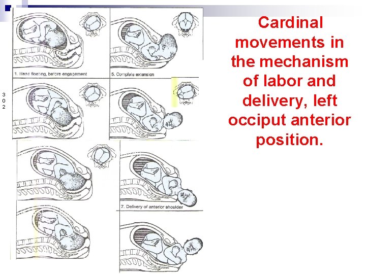 3 0 2 2. Engagement; descent, flexion 3. Further descent, internal rotation 4. Complete