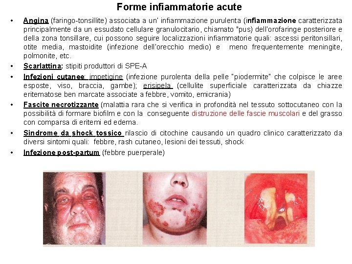 Forme infiammatorie acute • • • Angina (faringo-tonsillite) associata a un’ infiammazione purulenta (infiammazione