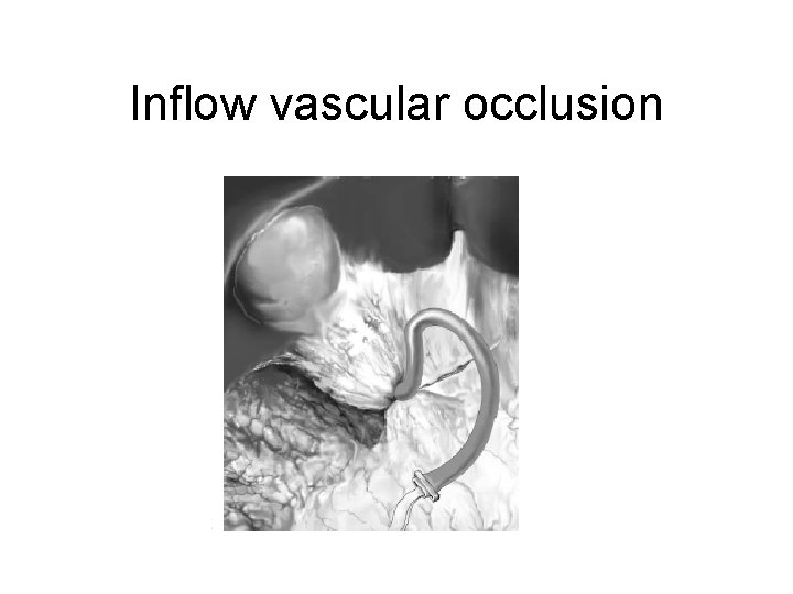 Inflow vascular occlusion 