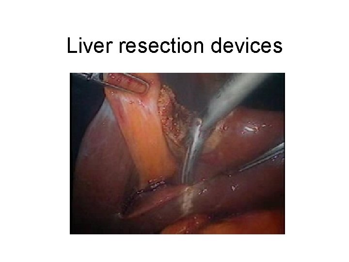 Liver resection devices 