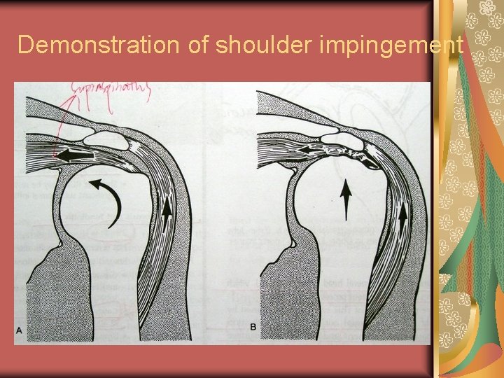 Demonstration of shoulder impingement 