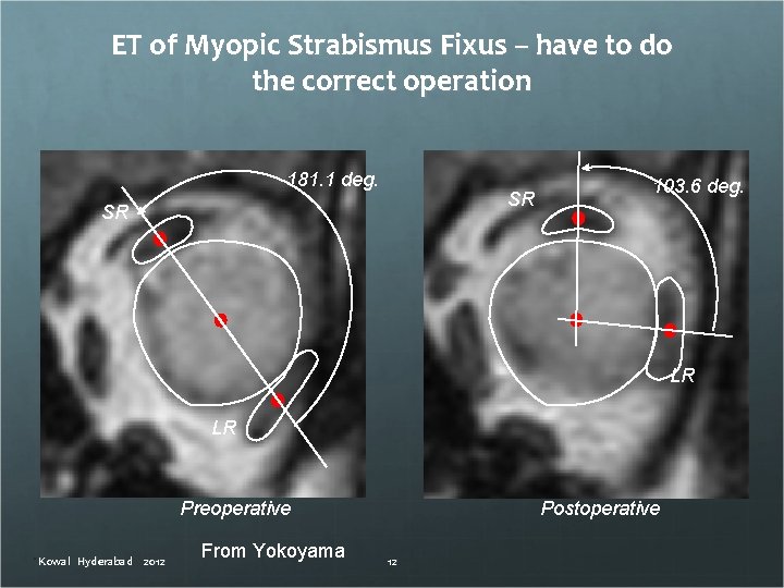 ET of Myopic Strabismus Fixus – have to do the correct operation 181. 1