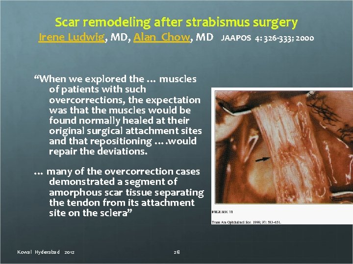 Scar remodeling after strabismus surgery Irene Ludwig, MD, Alan Chow, MD “When we explored