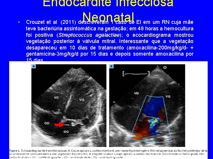  • Endocardite Infecciosa Neonatal Crouzet et al (2011) descreveram 1 caso de EI