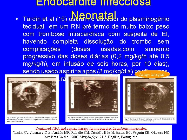  • Endocardite Infecciosa Neonatal Tardin et al (15) usaram o ativador do plasminogênio