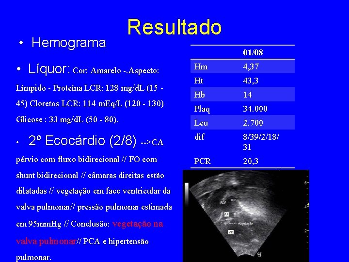  • Hemograma Resultado • Líquor: Cor: Amarelo -. Aspecto: Límpido - Proteína LCR: