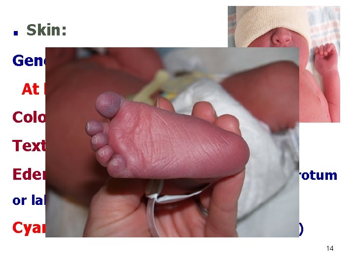 . Skin: General description: At birth: Color: bright red. Texture: soft and has good