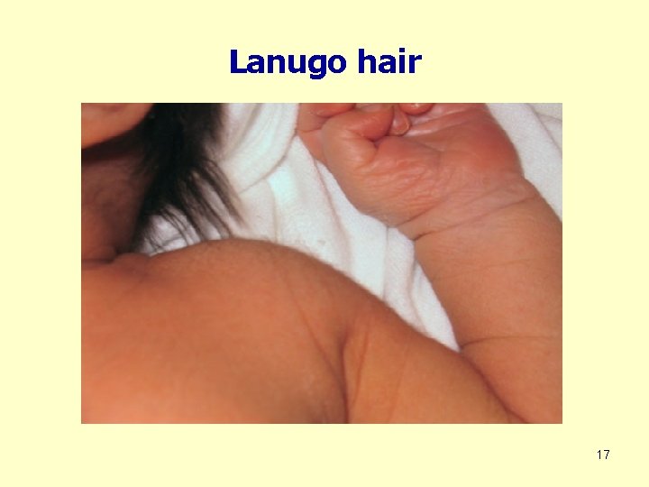 Lanugo hair 17 