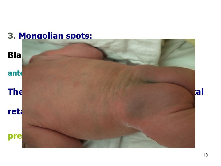 3. Mongolian spots: Black coloration on the lower back, buttocks, anterior trunk, & around