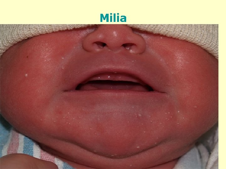 Milia 22 
