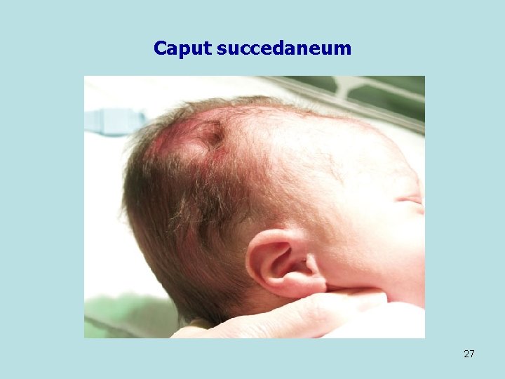 Caput succedaneum 27 