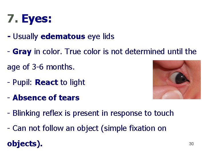 7. Eyes: - Usually edematous eye lids - Gray in color. True color is