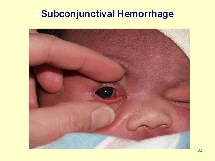 Subconjunctival Hemorrhage 33 
