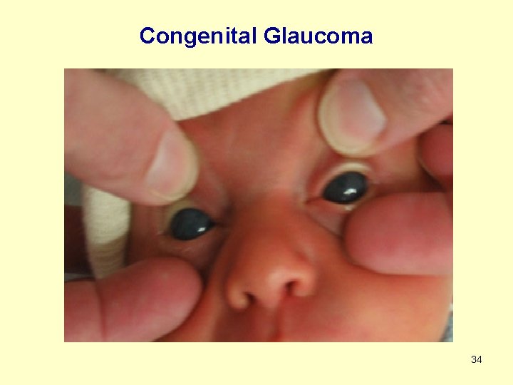 Congenital Glaucoma 34 