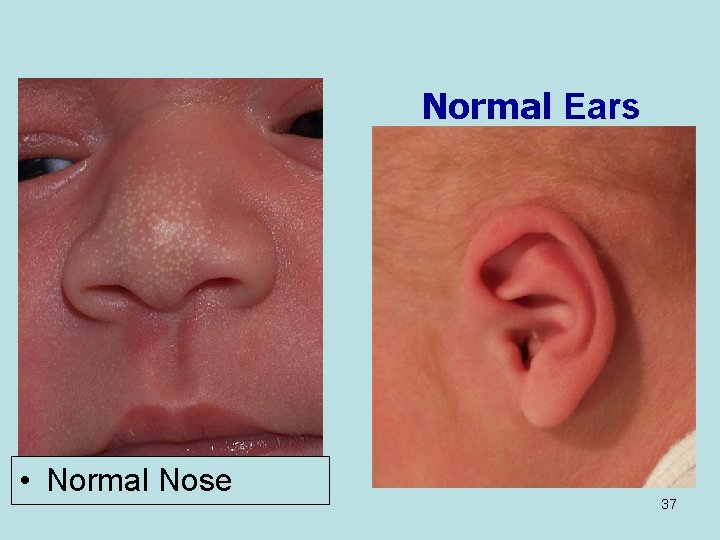 Normal Ears • Normal Nose 37 