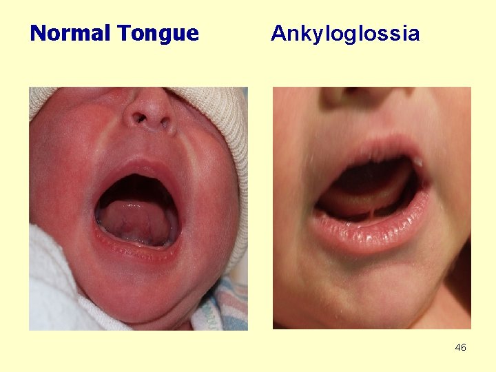 Normal Tongue Ankyloglossia 46 